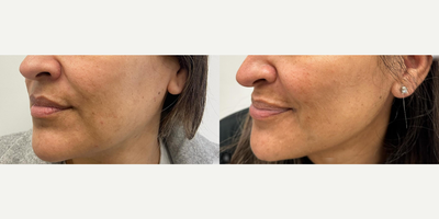 Case 11365 - Woman treated with Microneedling, VI Peel, SkinPen