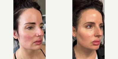 Case 11367 - Woman treated with Facial, Microneedling