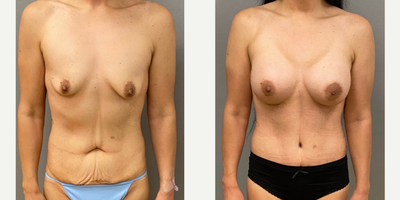Case: 11368 - before and after photo of 35-44 year old woman treated with Tummy Tuck, Mommy Makeover by Keshav Magge, MD