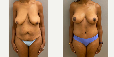 Case: 11369 - before and after photo of 55-64 year old woman treated with Breast Lift, Tummy Tuck, Mommy Makeover by Keshav Magge, MD