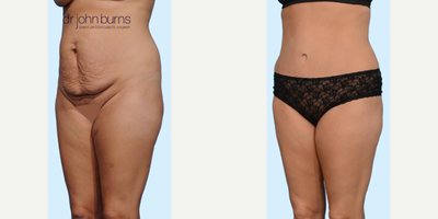 Case 1137 - Woman treated with Tummy Tuck