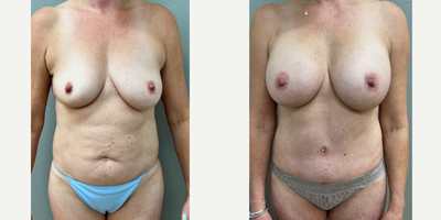 Case: 11370 - before and after photo of 45-54 year old woman treated with Mommy Makeover by Franklin D. Richards, MD