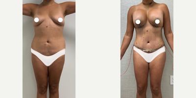 Case: 11371 - before and after photo of Woman treated with Mommy Makeover by S. Alexander Earle, MD, FACS