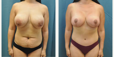 Case: 11373 - before and after photo of Woman treated with Mommy Makeover, Tummy Tuck by Richard H. Lee, MD