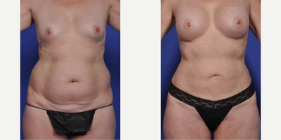 Case: 11374 - before and after photo of Woman treated with Mommy Makeover by Harry T. Haramis, MD, FACS