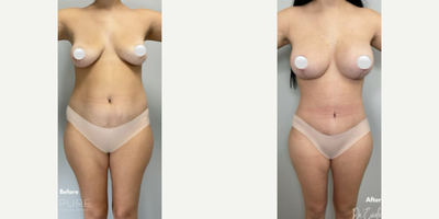 Case: 11375 - before and after photo of Woman treated with Mommy Makeover by S. Alexander Earle, MD, FACS
