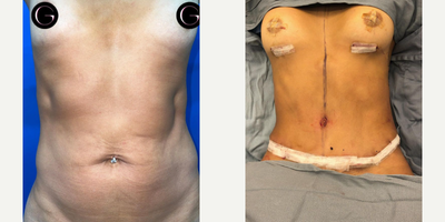 Case: 11376 - before and after photo of Woman treated with Breast Augmentation, Tummy Tuck, Mommy Makeover by Stephen T. Greenberg, MD, FACS