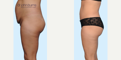 Case 1138 - Woman treated with Tummy Tuck