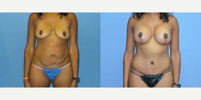 Case 11382 - 35 year old woman treated with Mommy Makeover