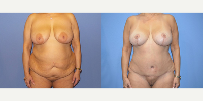 Case 11383 - 55 year old woman treated with Mommy Makeover