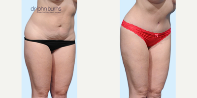 Case 1139 - Woman treated with Tummy Tuck