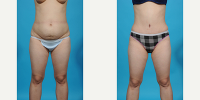 Case 11390 - 25-34 year old woman treated with Diastasis Recti Repair and Tummy Tuck