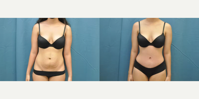 Case 114 - Woman treated with Tummy Tuck