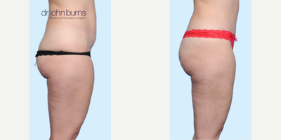 Case 1140 - Woman treated with Tummy Tuck