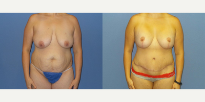 Case 11402 - 35-44 year old woman treated with Mommy Makeover