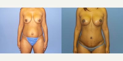 Case 11403 - 35-44 year old woman treated with Mommy Makeover