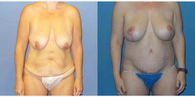 Case 11404 - 45-54 year old woman treated with Mommy Makeover