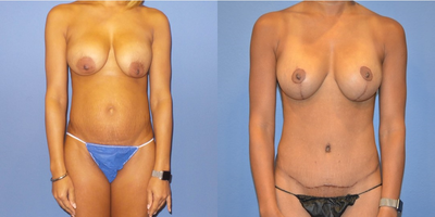 Case 11405 - 35-44 year old woman treated with Mommy Makeover