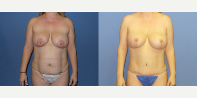 Case 11406 - 35-44 year old woman treated with Mommy Makeover