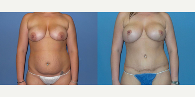 Case 11408 - 25-34 year old woman treated with Mommy Makeover