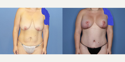 Case 11409 - 25-34 year old woman treated with Mommy Makeover