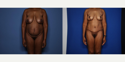 Case 11410 - 35-44 year old woman treated with Mommy Makeover