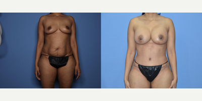 Case 11411 - 35-44 year old woman treated with Mommy Makeover