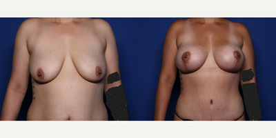 Case 11412 - 25-34 year old woman treated with Mommy Makeover