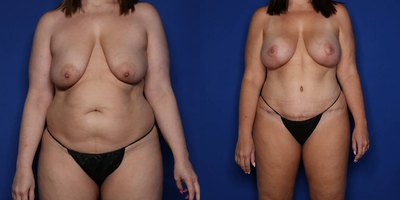 Case 11413 - 45-54 year old woman treated with Mommy Makeover