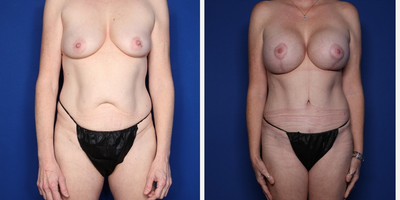 Case 11419 - 45-54 year old woman treated with Mommy Makeover