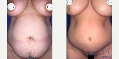 Case 11423 - Woman treated with Mommy Makeover