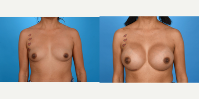 Case 11428 - 25-34 year old woman treated with Mommy Makeover