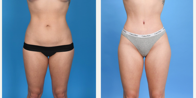 Case 11430 - 25-34 year old woman treated with Mommy Makeover