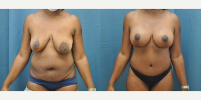 Case 11431 - Woman treated with Mommy Makeover