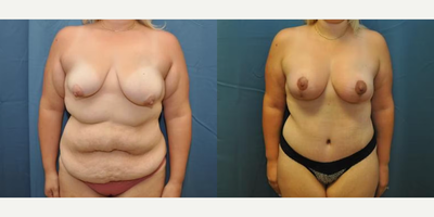 Case 11432 - Woman treated with Mommy Makeover