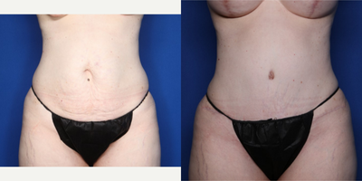 Case 11436 - 35-44 year old woman treated with Mommy Makeover, Breast Lift with Implants, Natrelle Breast Implants, Tummy Tuck