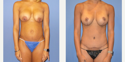 Case 11439 - 37 year old woman treated with Mommy Makeover