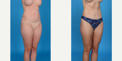 Case 1144 - 35-44 year old woman treated with Abdominal Etching, Belly Button Surgery, Diastasis Recti Repair, Drainless Tummy Tuck, Liposcu