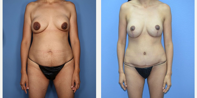 Case 11440 - 40 year old woman treated with Mommy Makeover