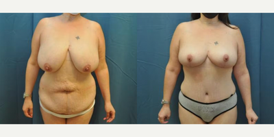 Case 11444 - Woman treated with Mommy Makeover