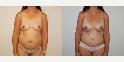 Case 11445 - Woman treated with Mommy Makeover