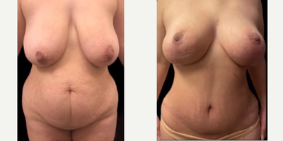 Case 11446 - 35-44 year old woman treated with Tummy Tuck, Breast Lift, Breast Implants, Mommy Makeover
