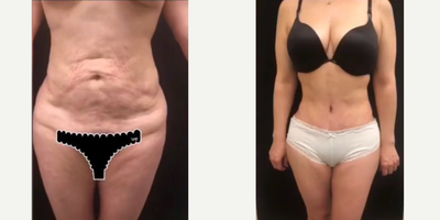 Case 11447 - 25-34 year old woman treated with Tummy Tuck, Mommy Makeover