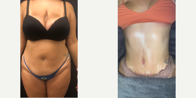 Case 11448 - 25-34 year old woman treated with Tummy Tuck, Liposuction, Mommy Makeover