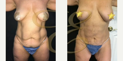 Case 11451 - Woman treated with Mommy Makeover