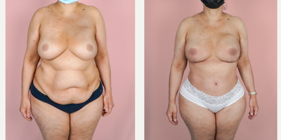 Case 11458 - 45-54 year old woman treated with Mommy Makeover