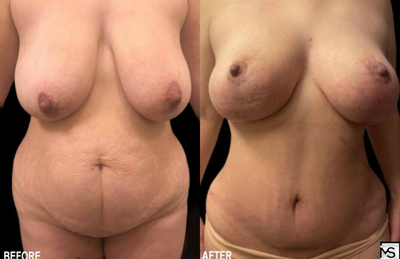 Case 11465 - 40 year old woman treated with Mommy Makeover