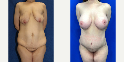 Case 11475 - 25-34 year old woman treated with Mommy Makeover