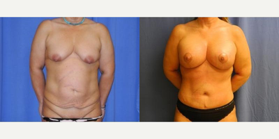 Case 11484 - Woman treated with Mommy Makeover