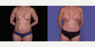 Case 11485 - Woman treated with Mommy Makeover